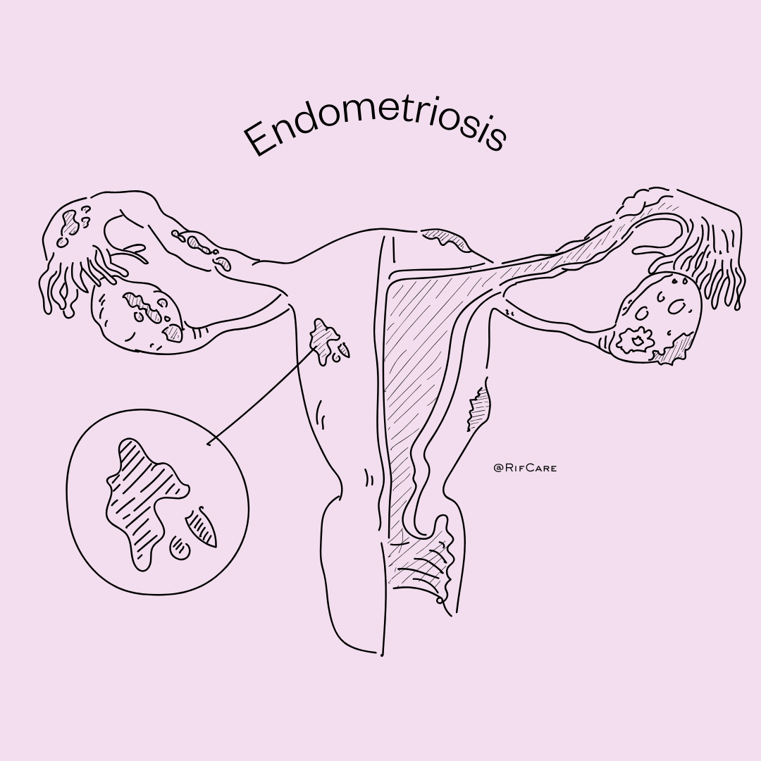 What Is Endometriosis? Its ENDO awareness month